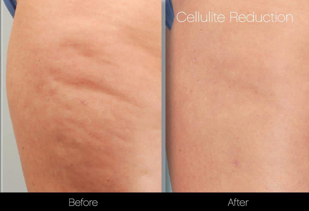 Cellutite -Before and After Gallery - Patient Photo 13