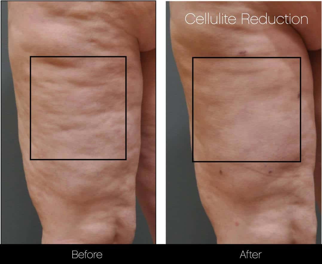 Cellutite -Before and After Gallery - Patient Photo 14