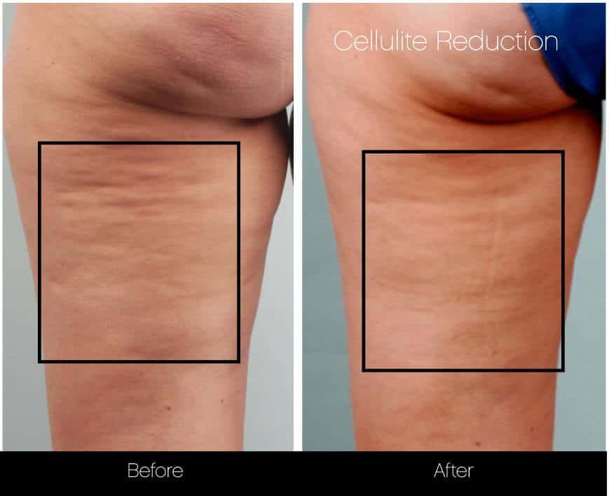 Cellutite -Before and After Gallery - Patient Photo 15