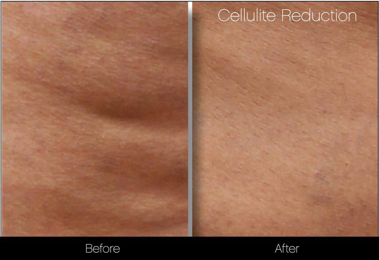 Cellutite -Before and After Gallery - Patient Photo 16