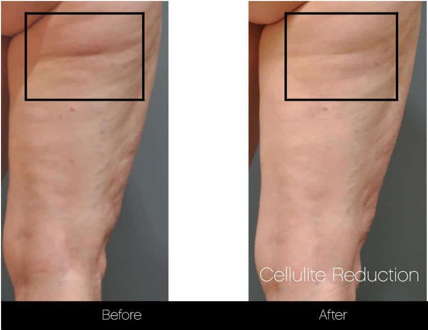 Cellutite -Before and After Gallery - Patient Photo 18