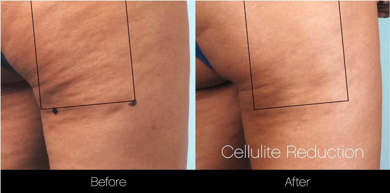 Cellutite -Before and After Gallery - Patient Photo 19