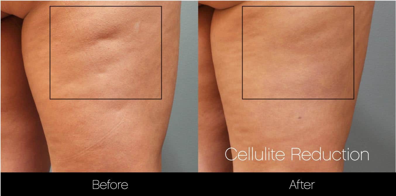 Cellutite -Before and After Gallery - Patient Photo 20