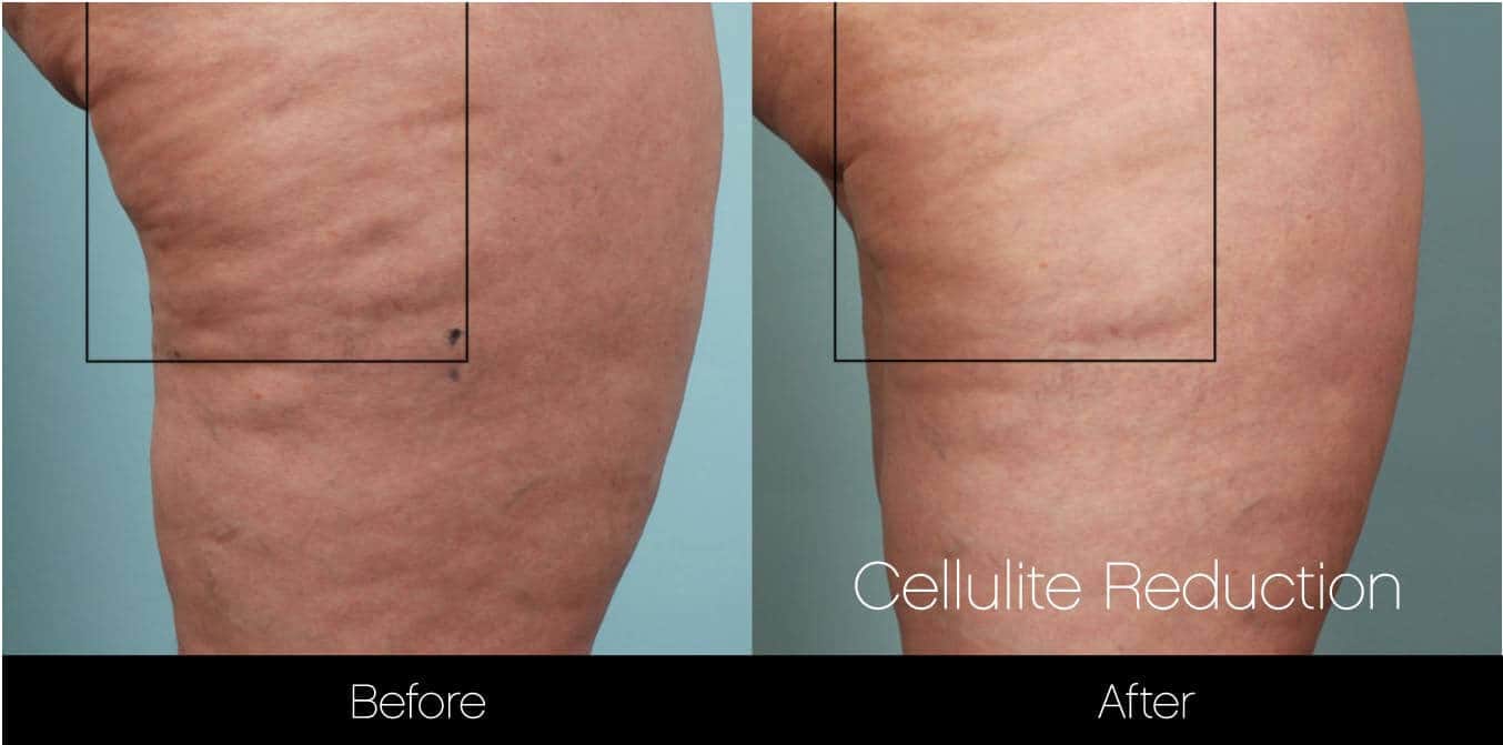 Cellutite -Before and After Gallery - Patient Photo 21
