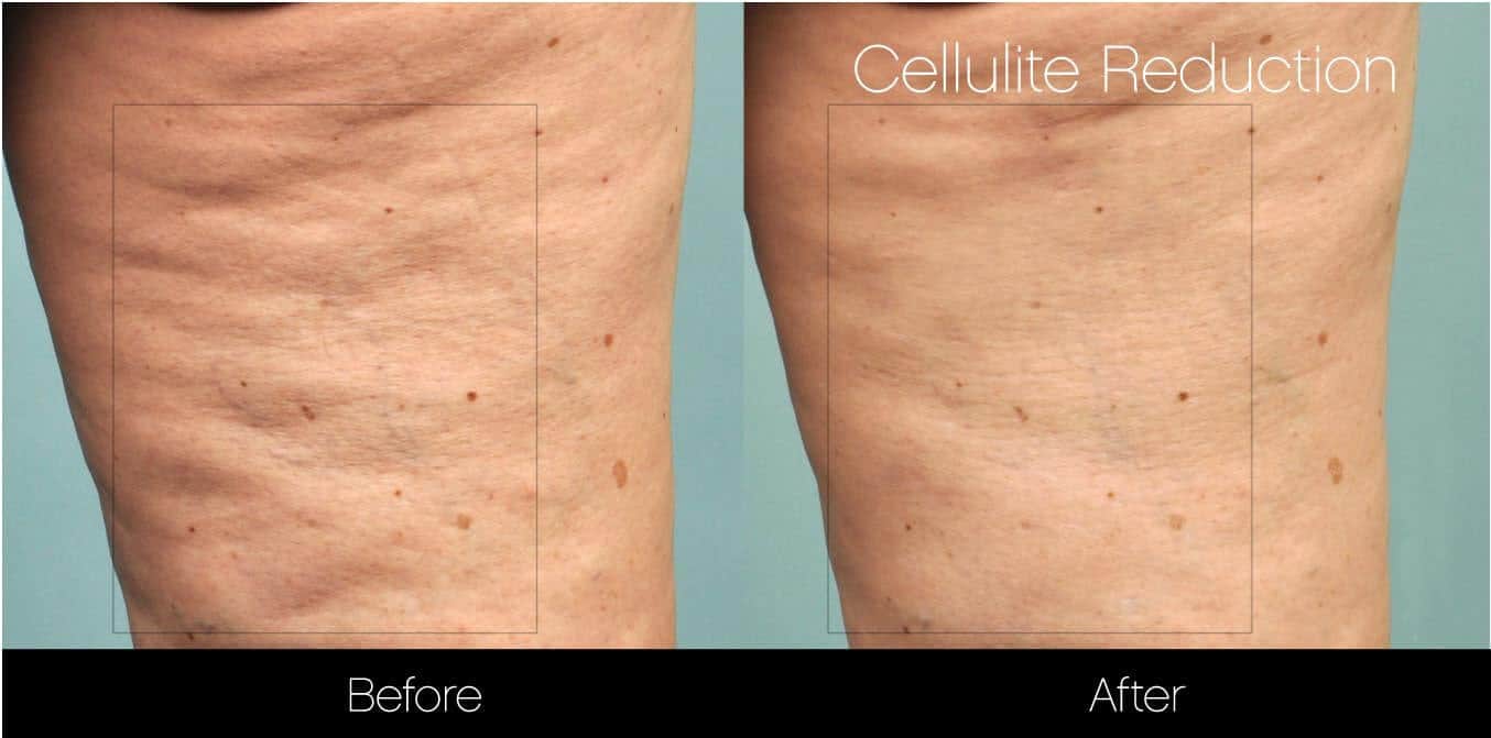 Cellutite -Before and After Gallery - Patient Photo 23