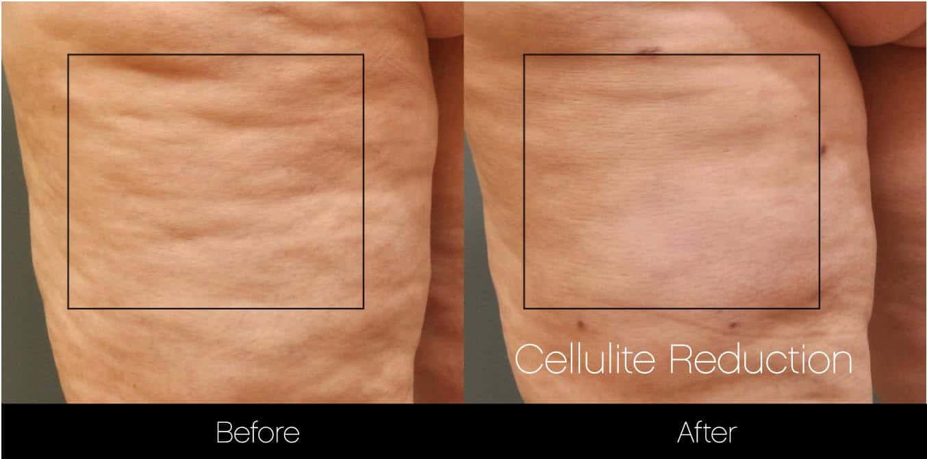 Cellutite -Before and After Gallery - Patient Photo 24