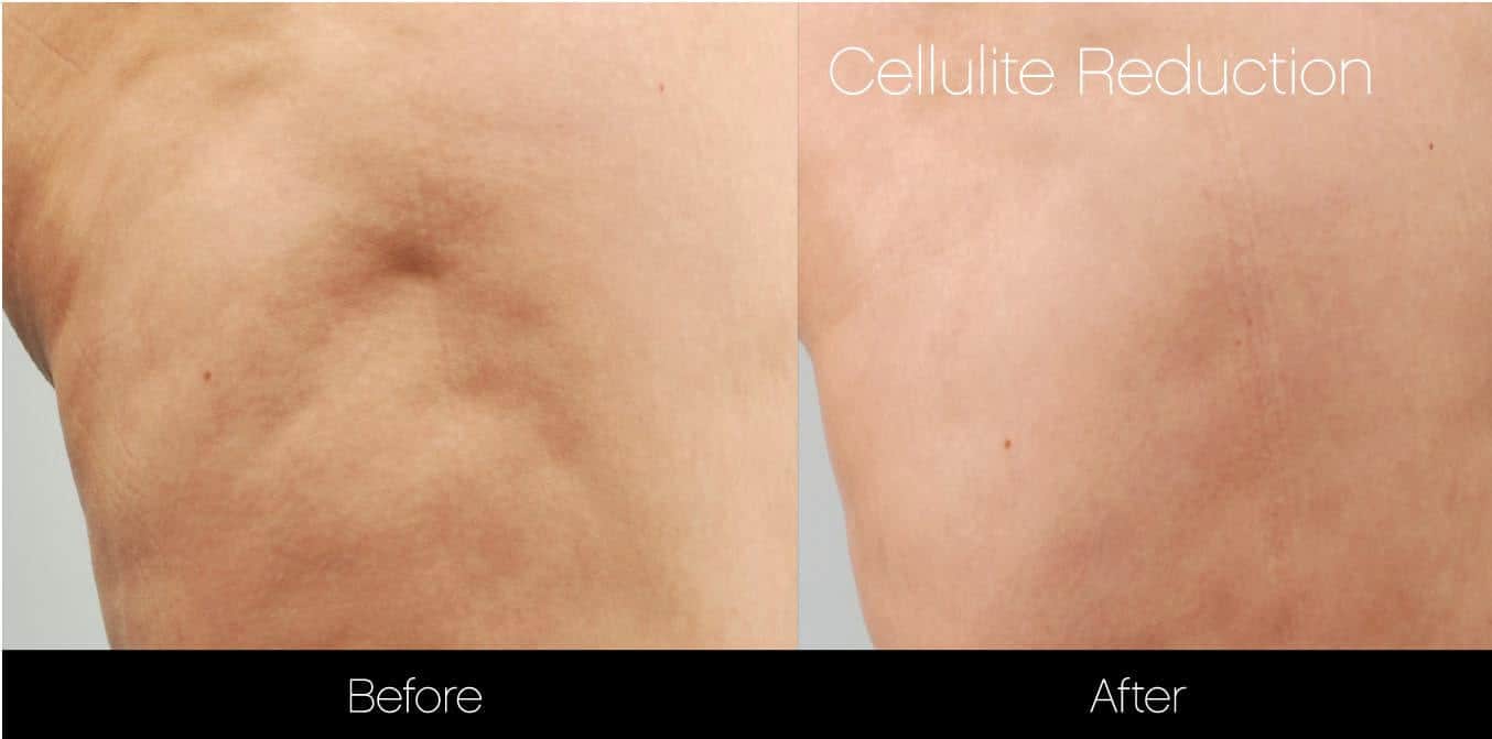 Cellutite -Before and After Gallery - Patient Photo 26