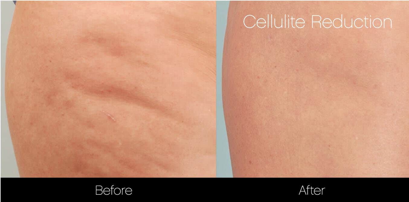 Cellutite -Before and After Gallery - Patient Photo 27