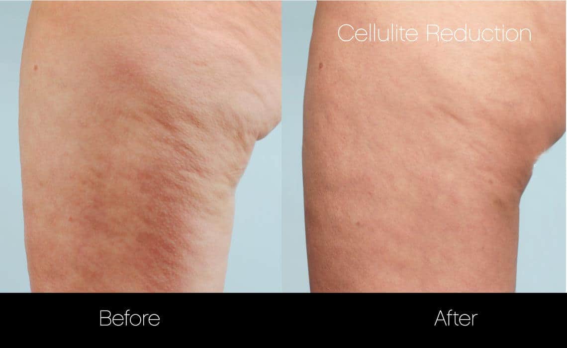 Cellutite -Before and After Gallery - Patient Photo 28
