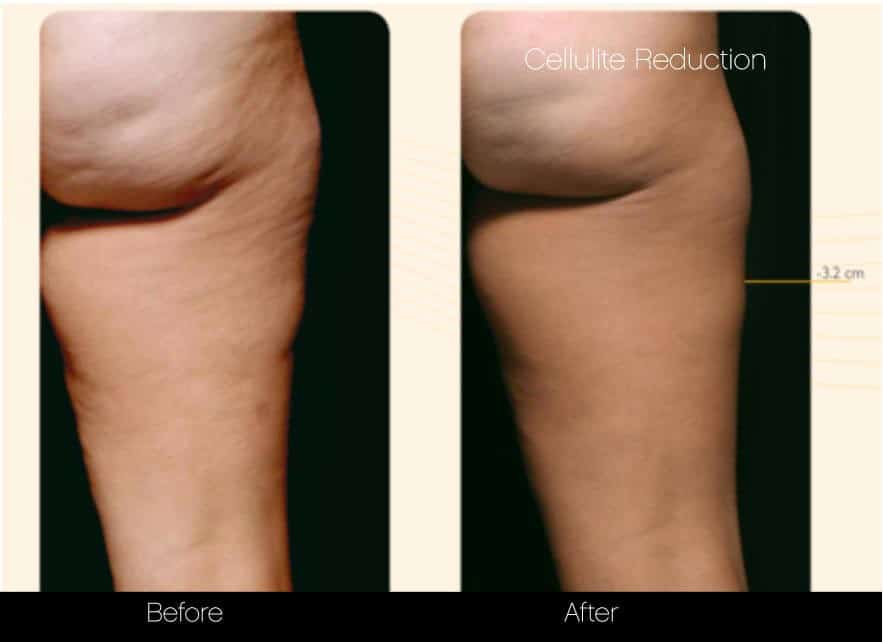 Cellutite -Before and After Gallery - Patient Photo 30