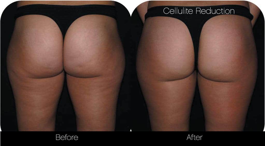 Cellutite -Before and After Gallery - Patient Photo 31