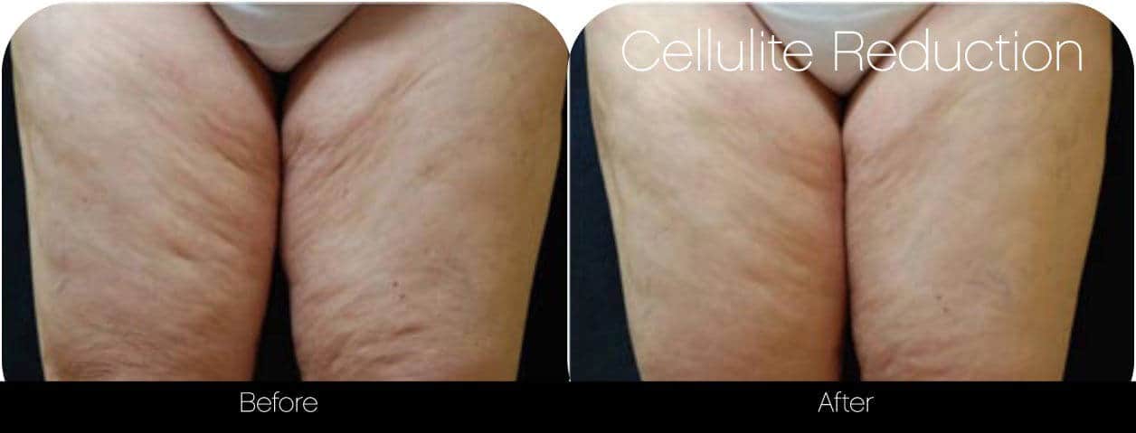 Cellutite -Before and After Gallery - Patient Photo 32