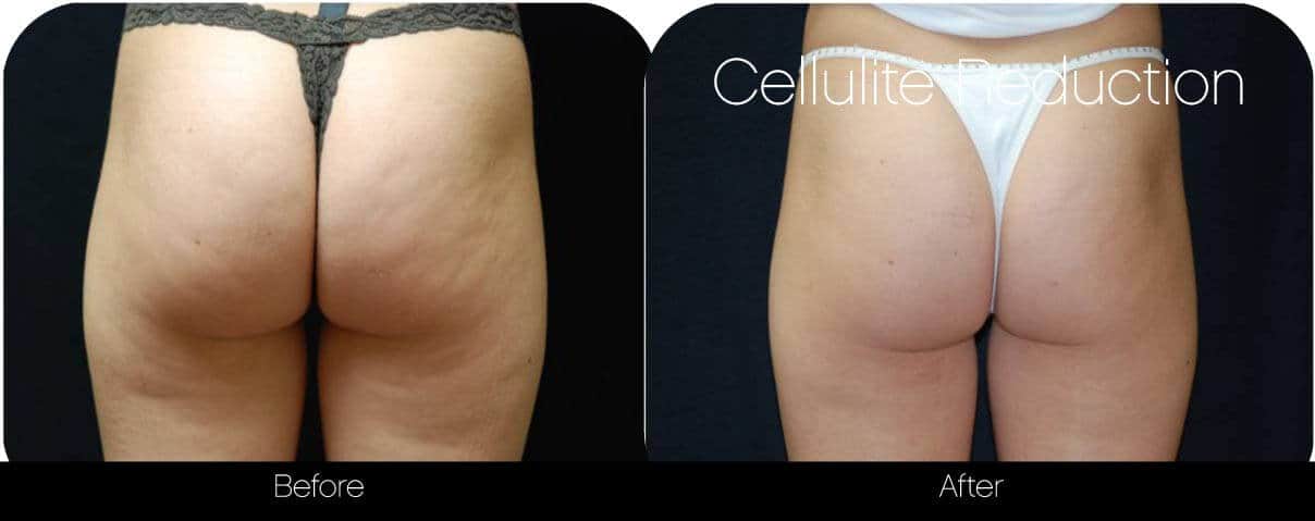 Cellutite -Before and After Gallery - Patient Photo 33