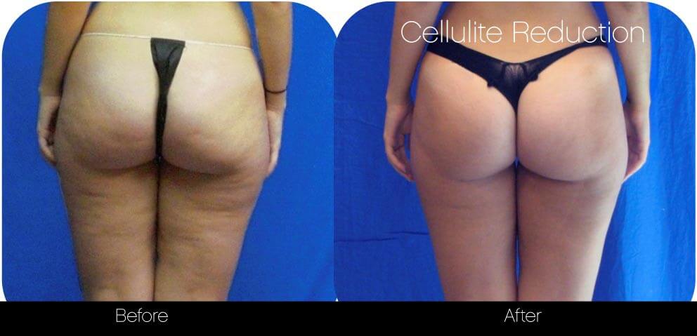 Cellutite -Before and After Gallery - Patient Photo 34