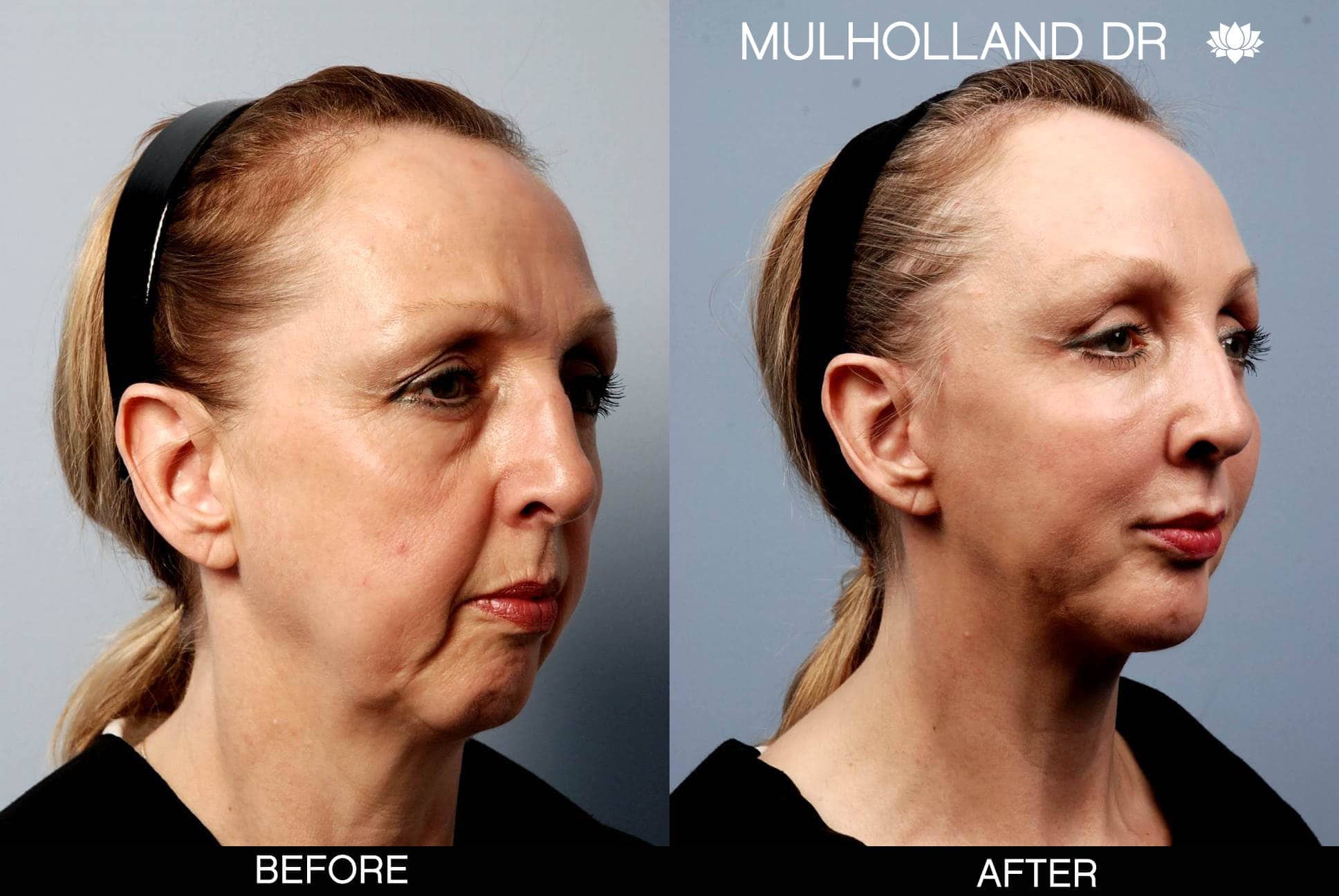Cheek Lift - Before and After Gallery - Patient Photo 1