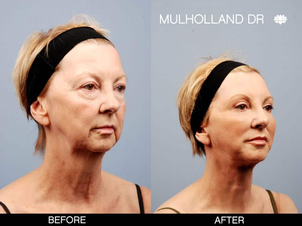 Cheek Lift - Before and After Gallery - Patient Photo 10