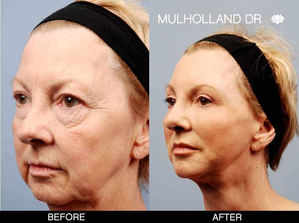 Cheek Lift - Before and After Gallery - Patient Photo 11