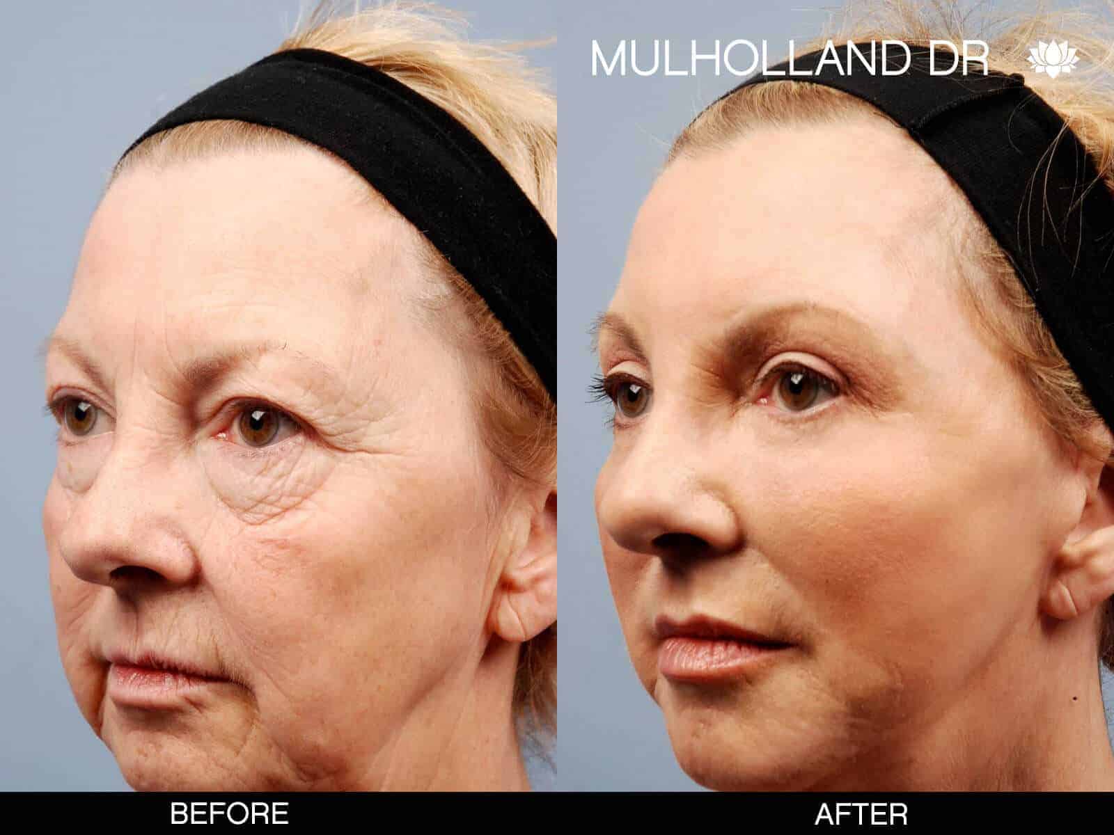 Cheek Lift - Before and After Gallery - Patient Photo 13