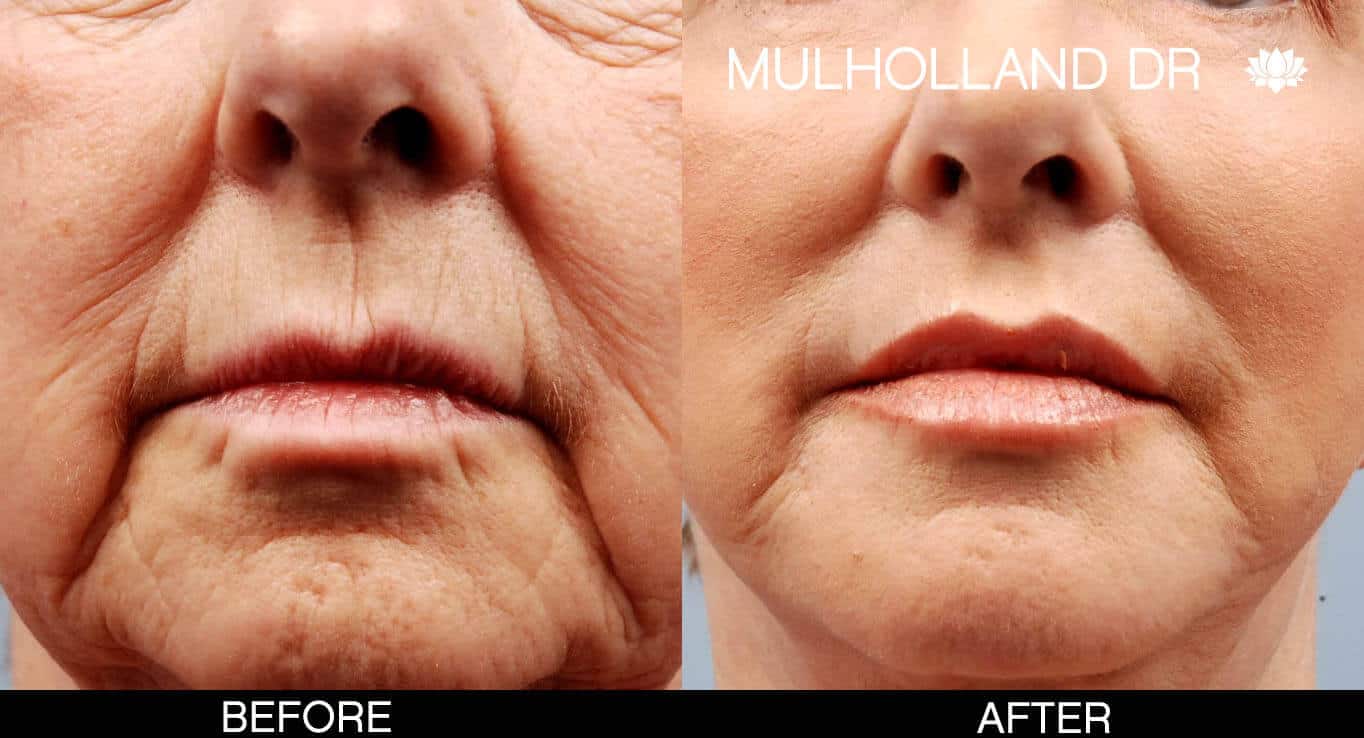 Cheek Lift - Before and After Gallery - Patient Photo 15