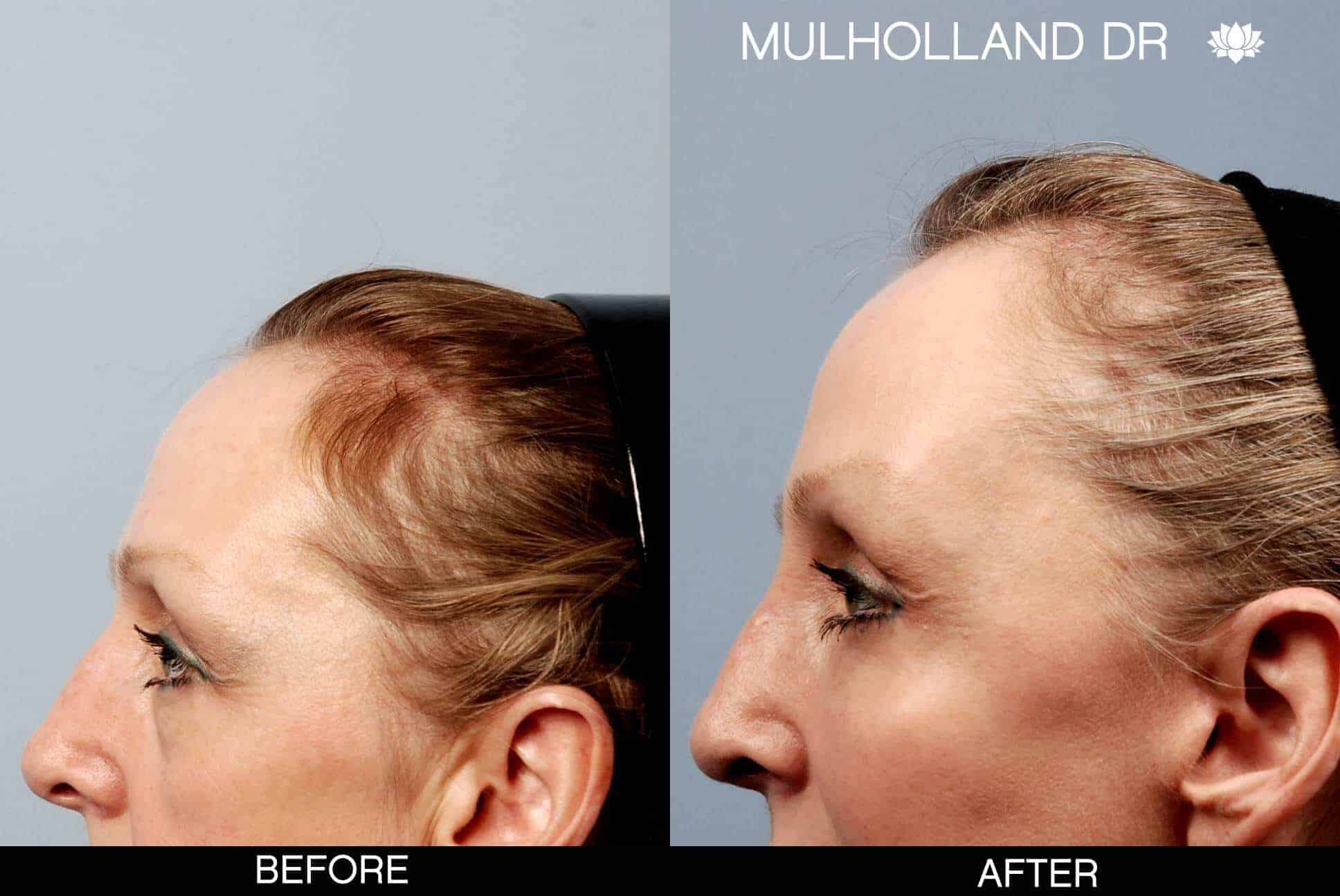 Cheek Lift - Before and After Gallery - Patient Photo 16