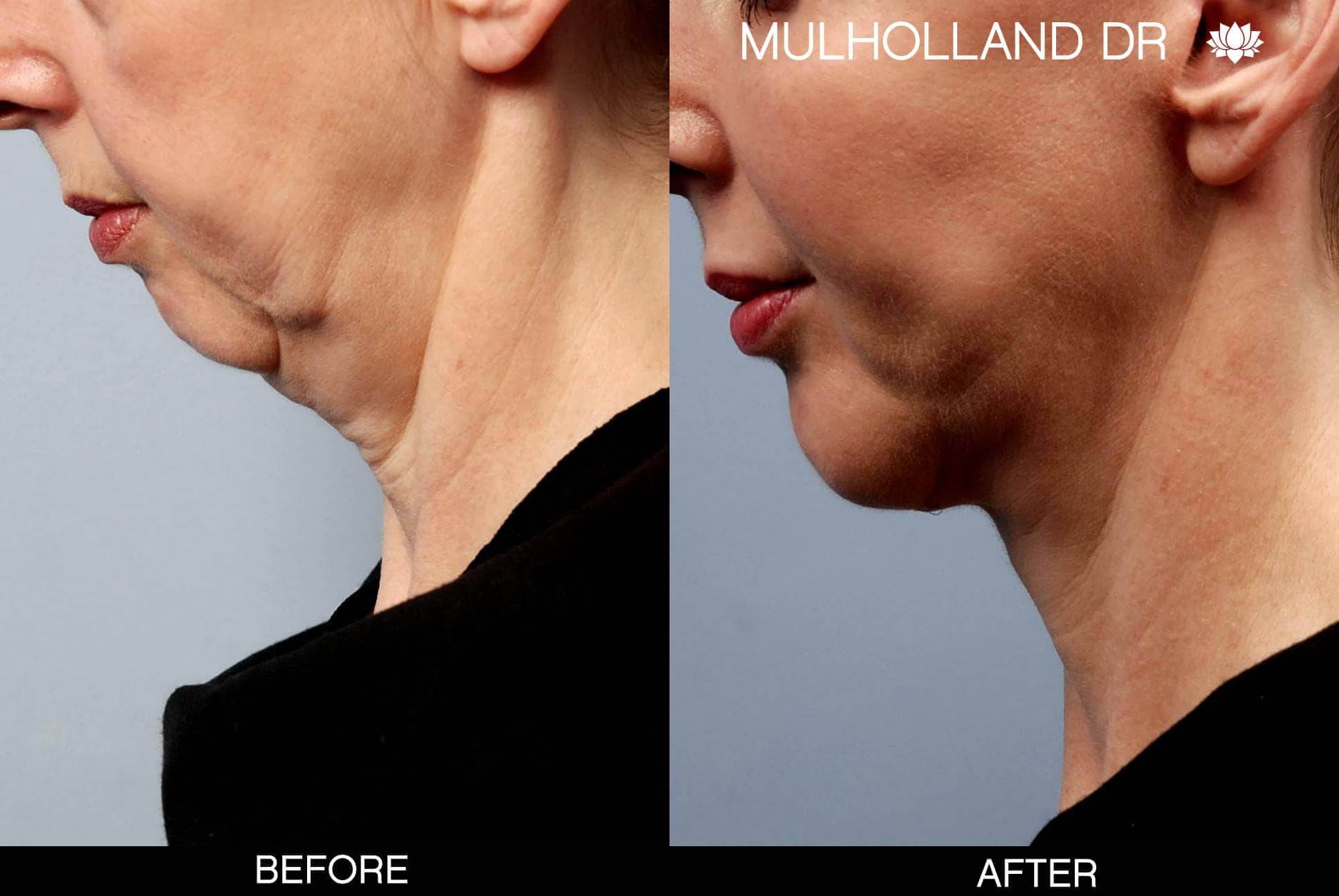 Cheek Lift - Before and After Gallery - Patient Photo 18