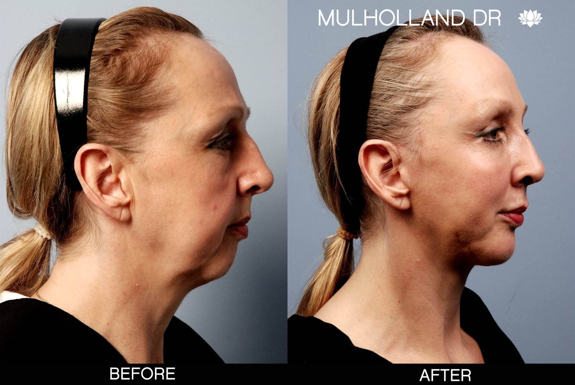 Cheek Lift - Before and After Gallery - Patient Photo 2