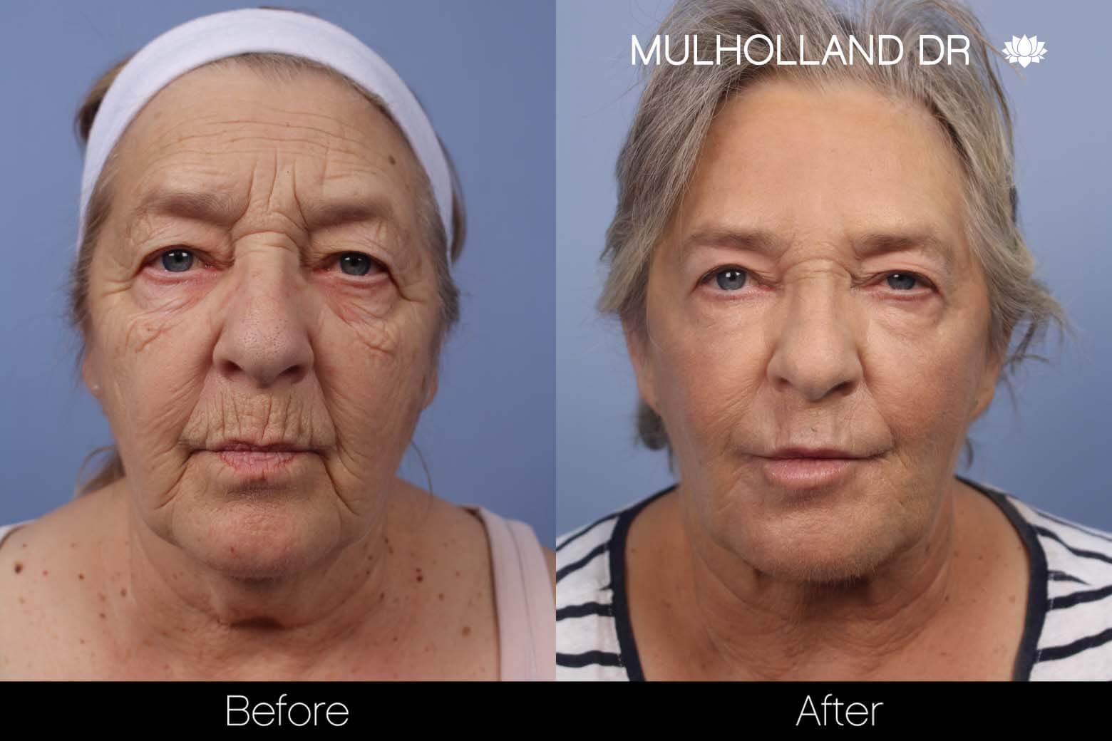 Cheek Lift - Before and After Gallery - Patient Photo 20