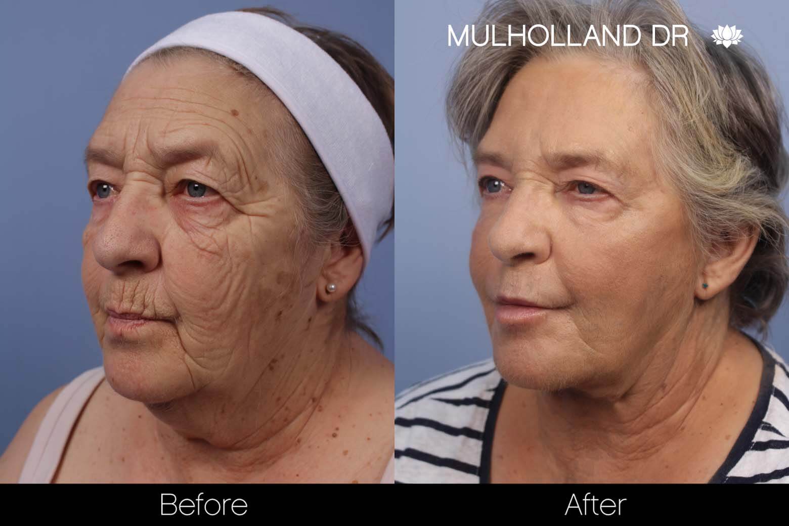 Cheek Lift - Before and After Gallery - Patient Photo 21