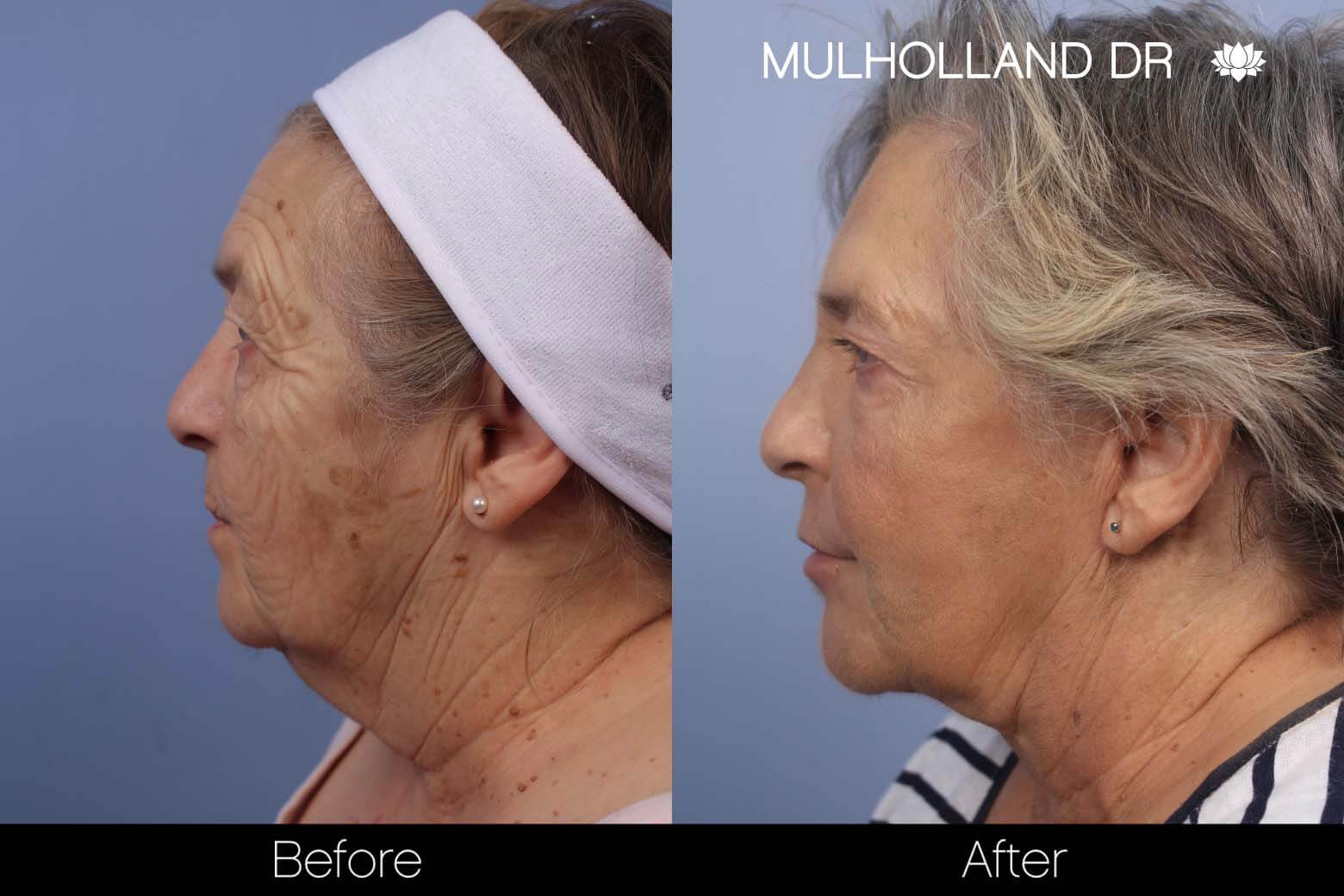 Cheek Lift - Before and After Gallery - Patient Photo 22