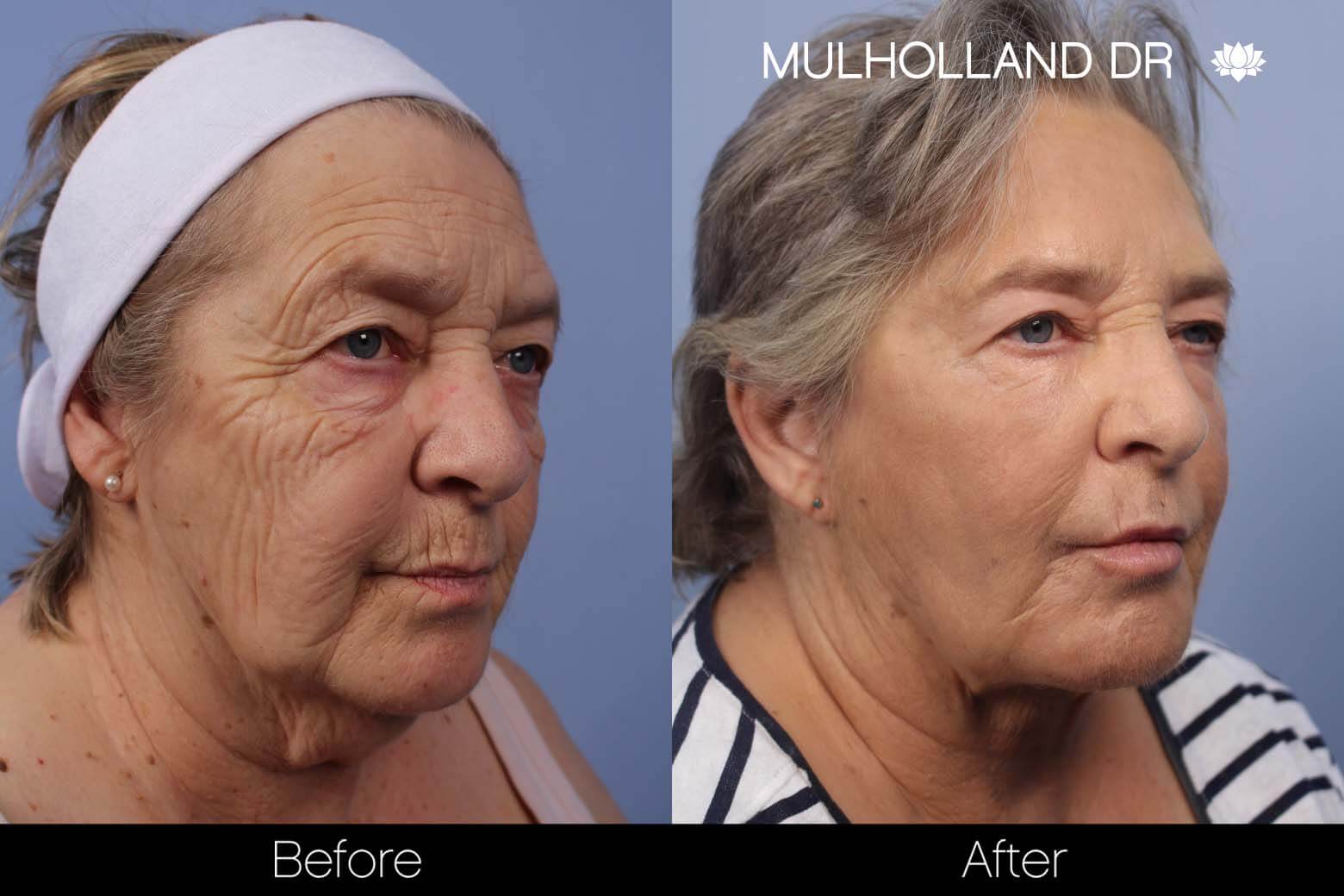 Cheek Lift - Before and After Gallery - Patient Photo 23