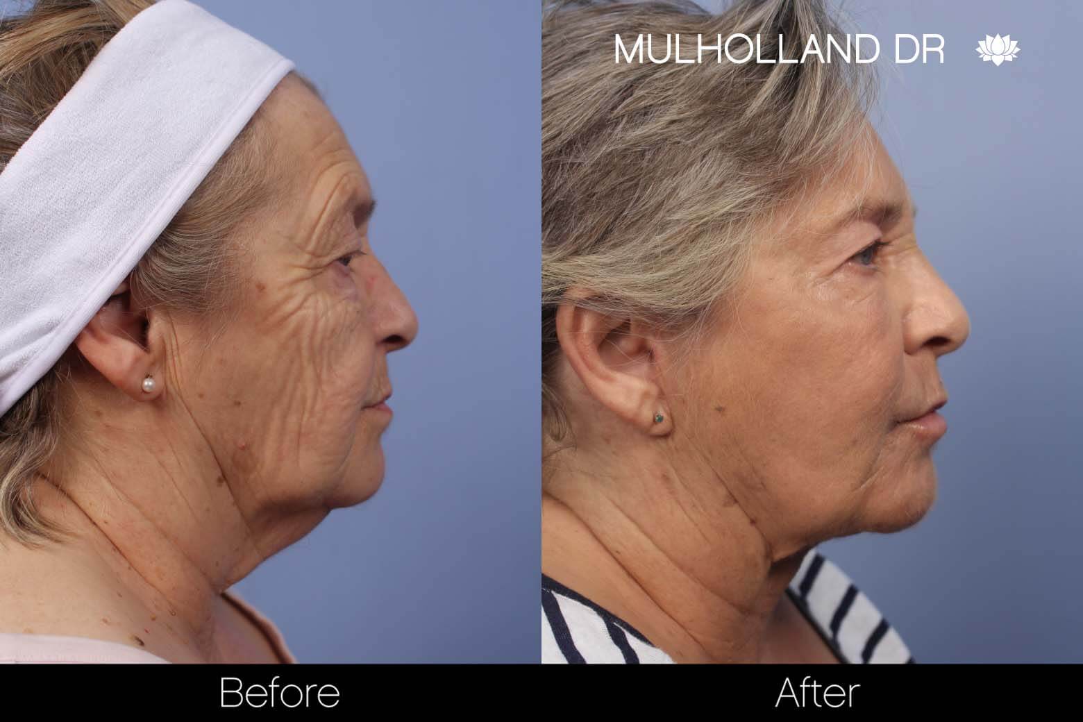 Cheek Lift - Before and After Gallery - Patient Photo 24