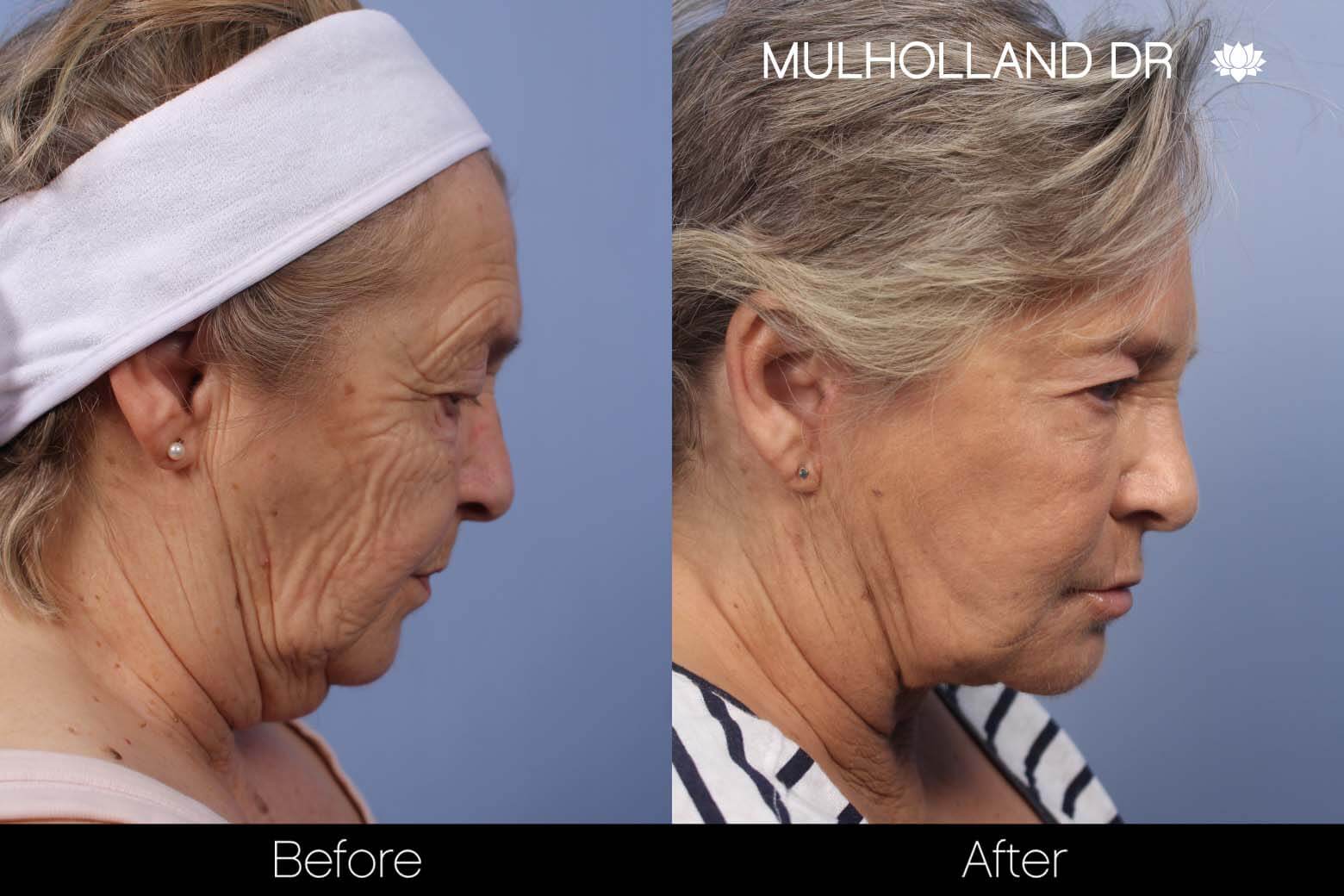Cheek Lift - Before and After Gallery - Patient Photo 25