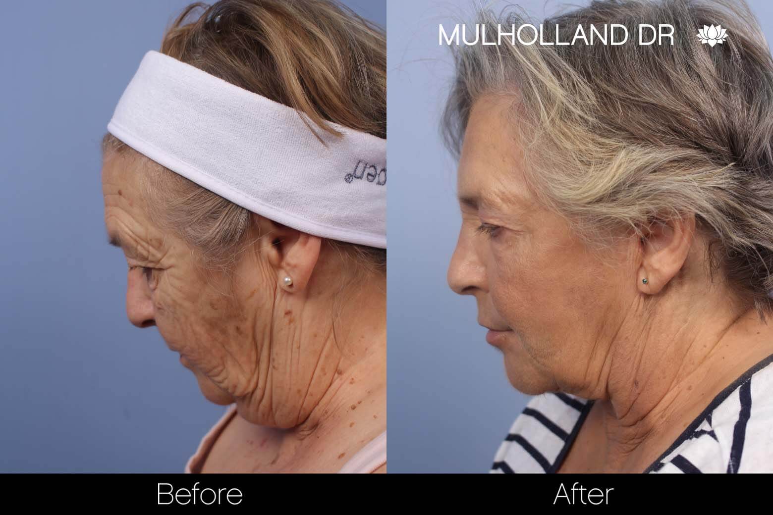 Cheek Lift - Before and After Gallery - Patient Photo 26