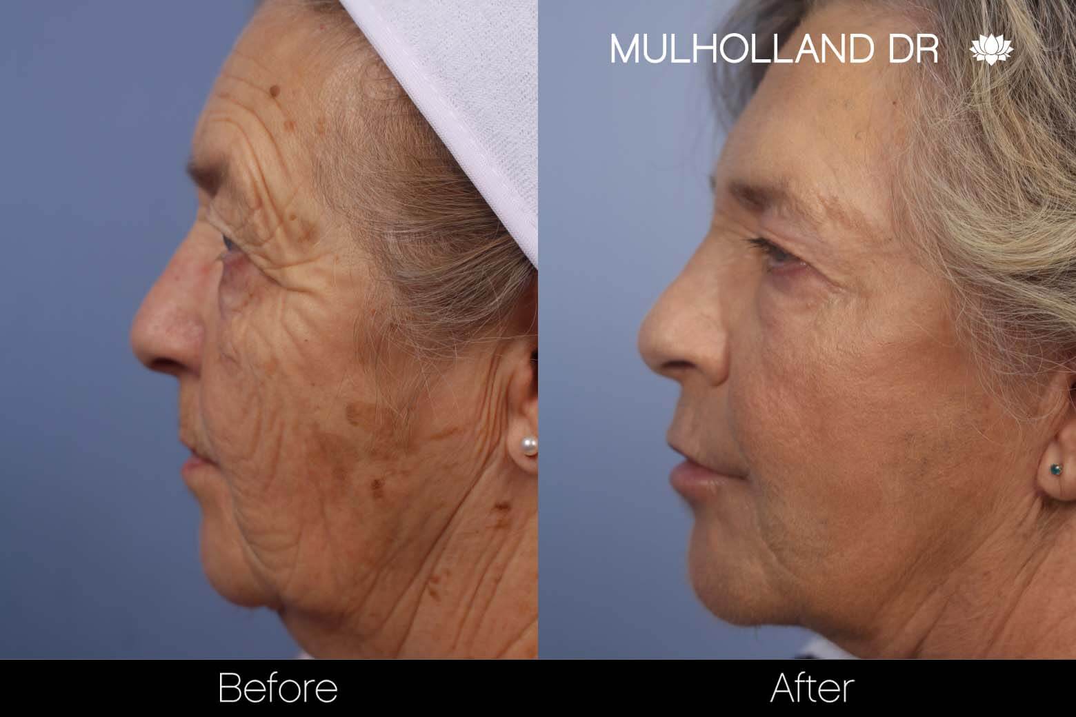 Cheek Lift - Before and After Gallery - Patient Photo 29
