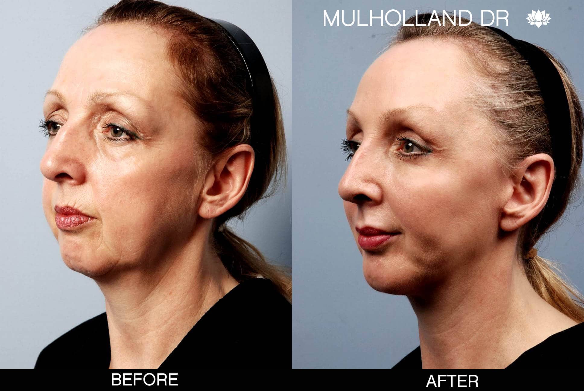 Cheek Lift - Before and After Gallery - Patient Photo 3