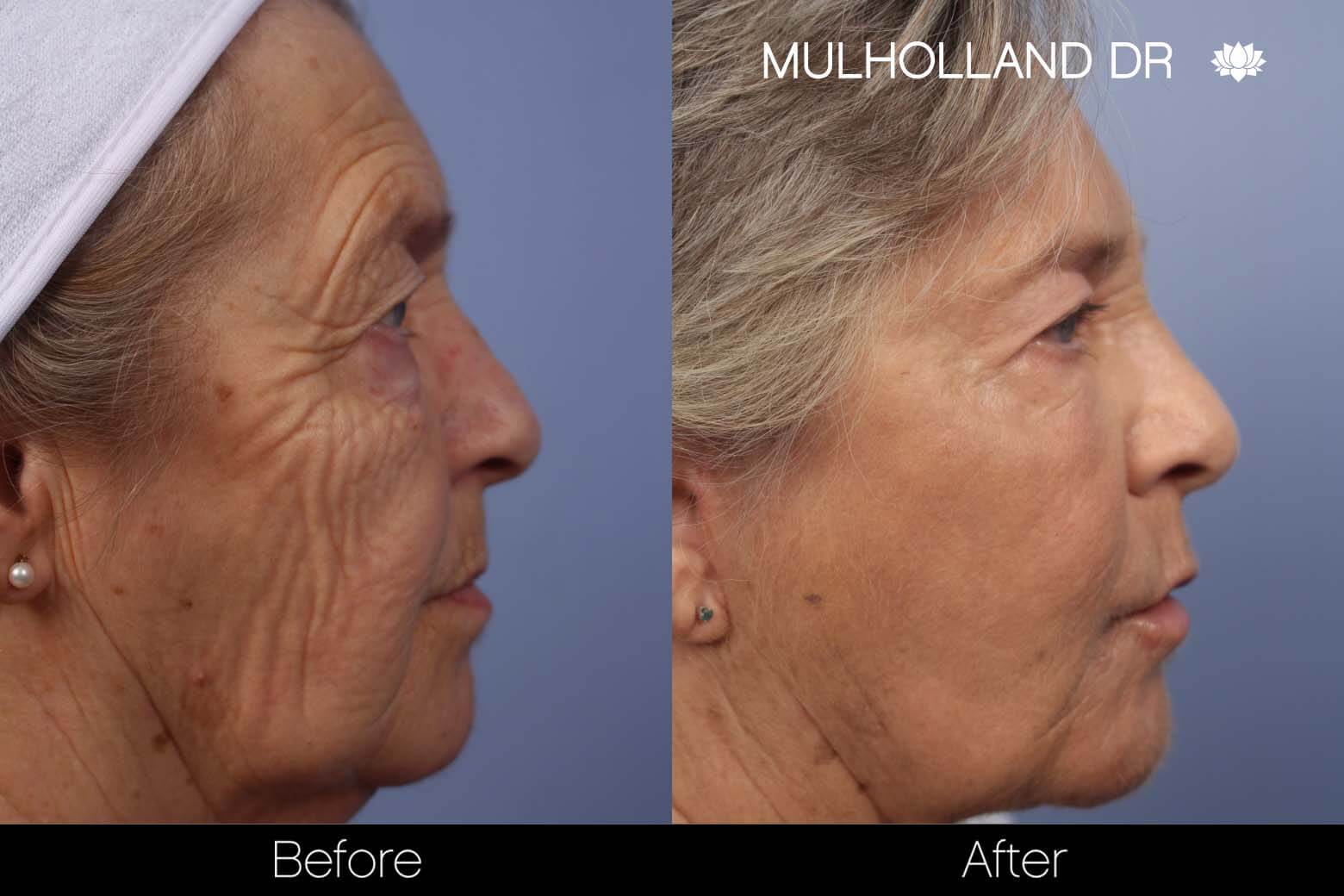 Cheek Lift - Before and After Gallery - Patient Photo 31