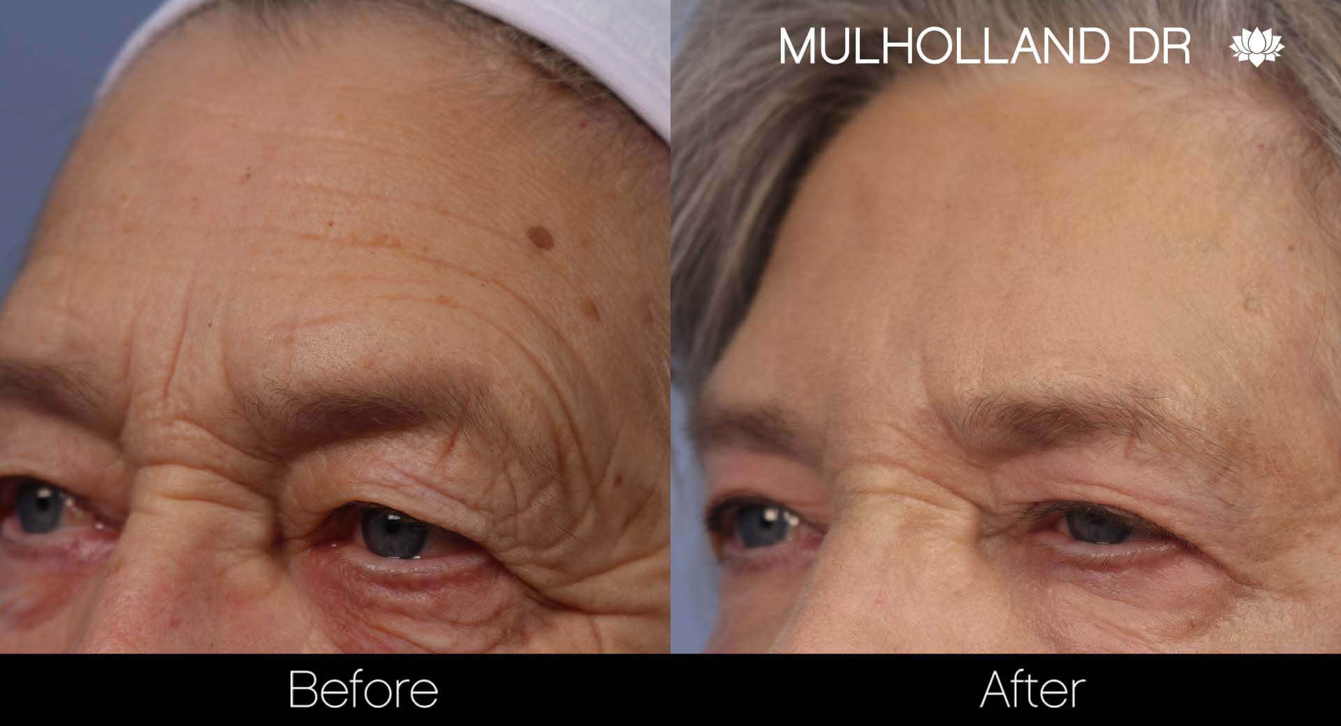 Cheek Lift - Before and After Gallery - Patient Photo 33