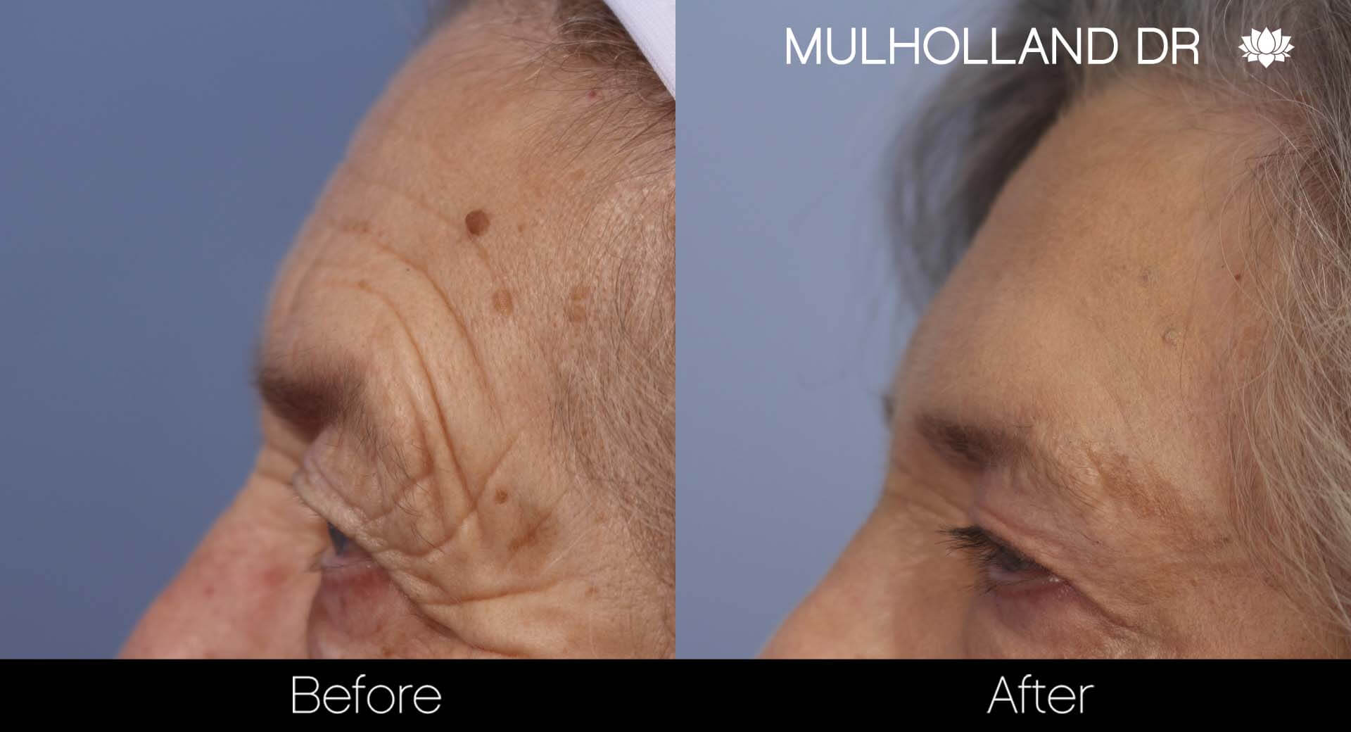 Cheek Lift - Before and After Gallery - Patient Photo 34
