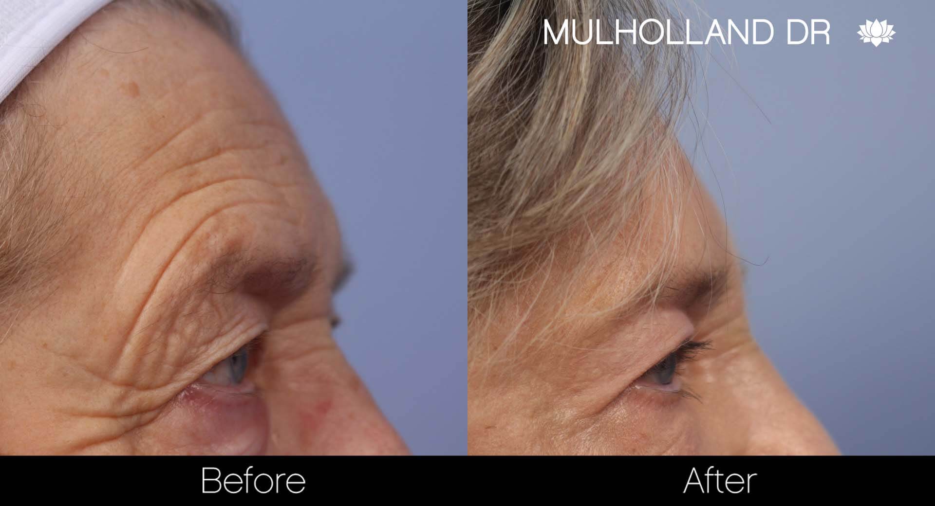 Cheek Lift - Before and After Gallery - Patient Photo 36