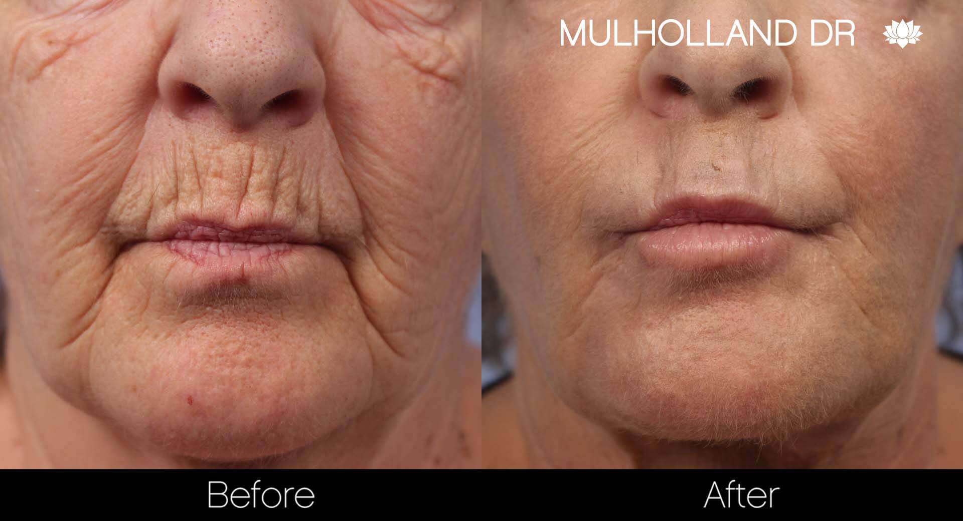 Cheek Lift - Before and After Gallery - Patient Photo 37