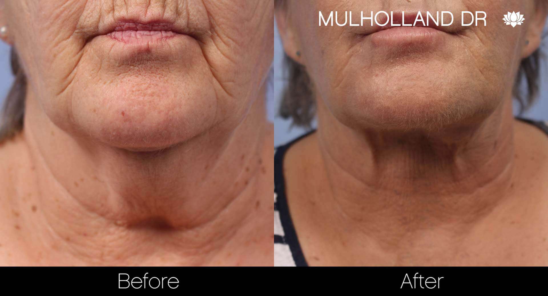 Cheek Lift - Before and After Gallery - Patient Photo 38