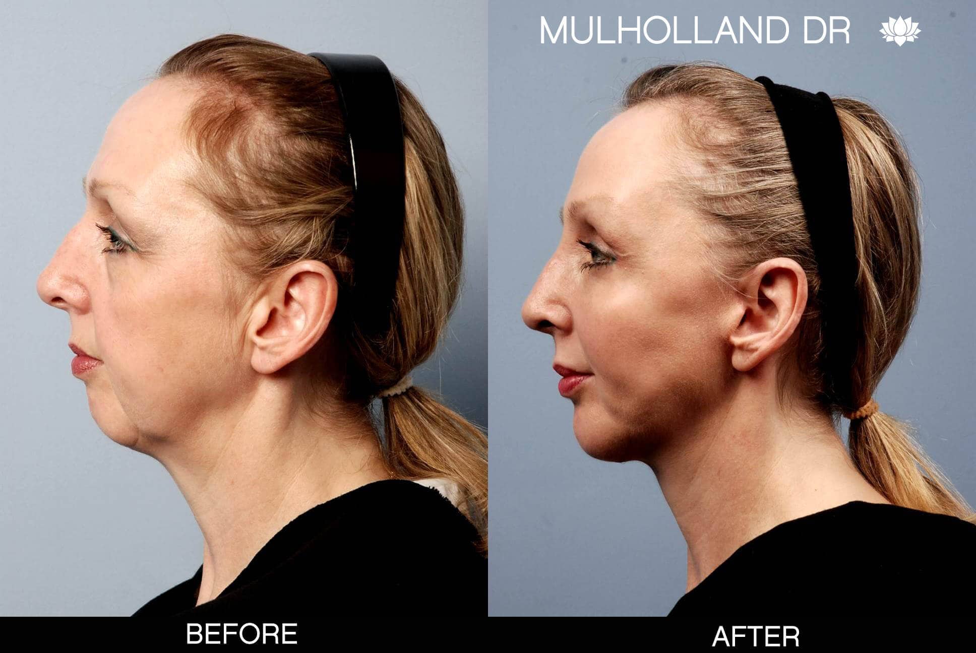 Cheek Lift - Before and After Gallery - Patient Photo 4