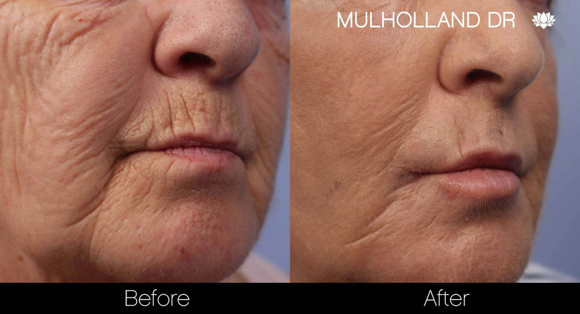 Cheek Lift - Before and After Gallery - Patient Photo 45