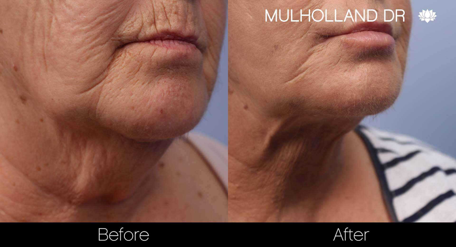Cheek Lift - Before and After Gallery - Patient Photo 46