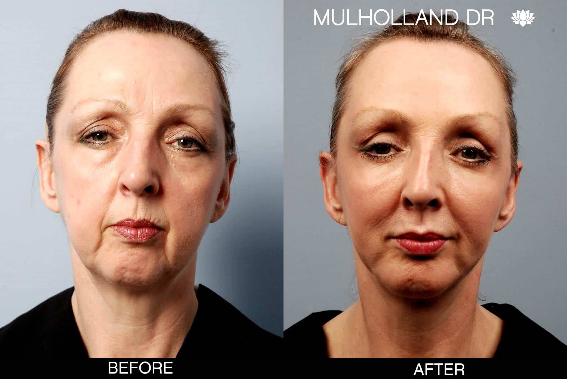 Cheek Lift - Before and After Gallery - Patient Photo 5