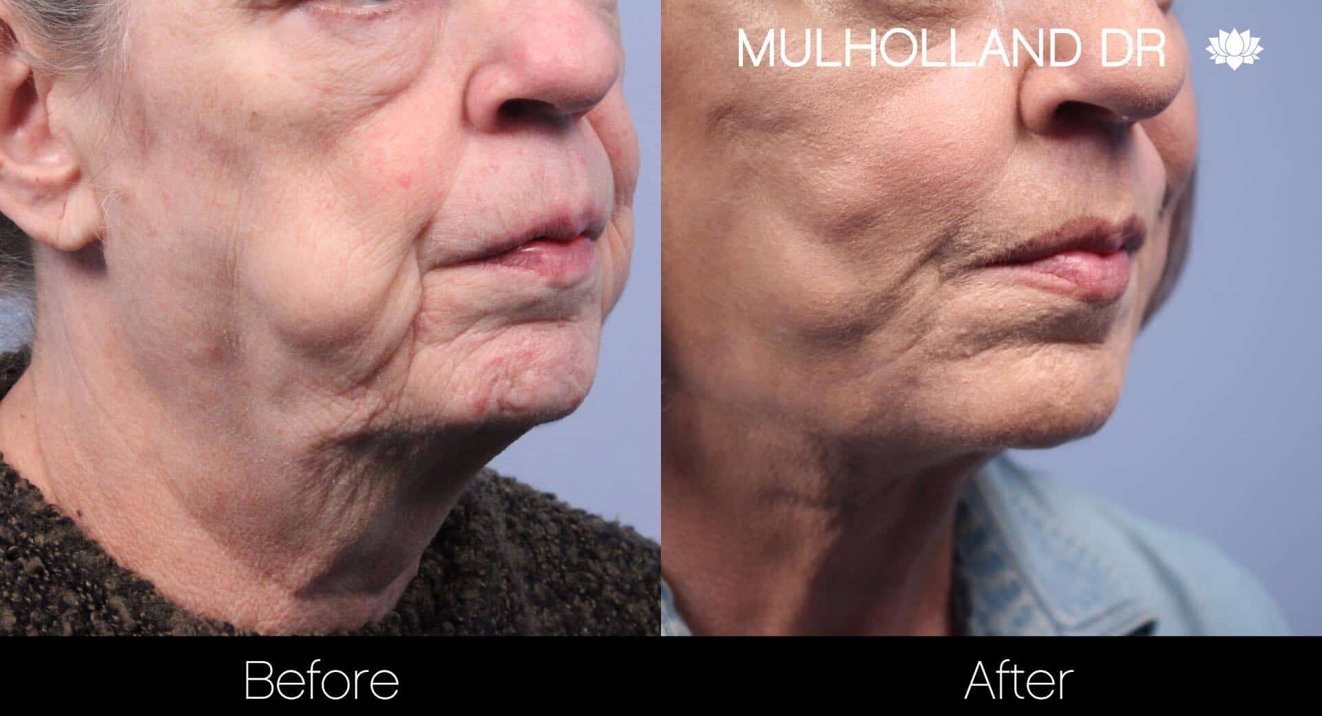 Cheek Lift - Before and After Gallery - Patient Photo 52
