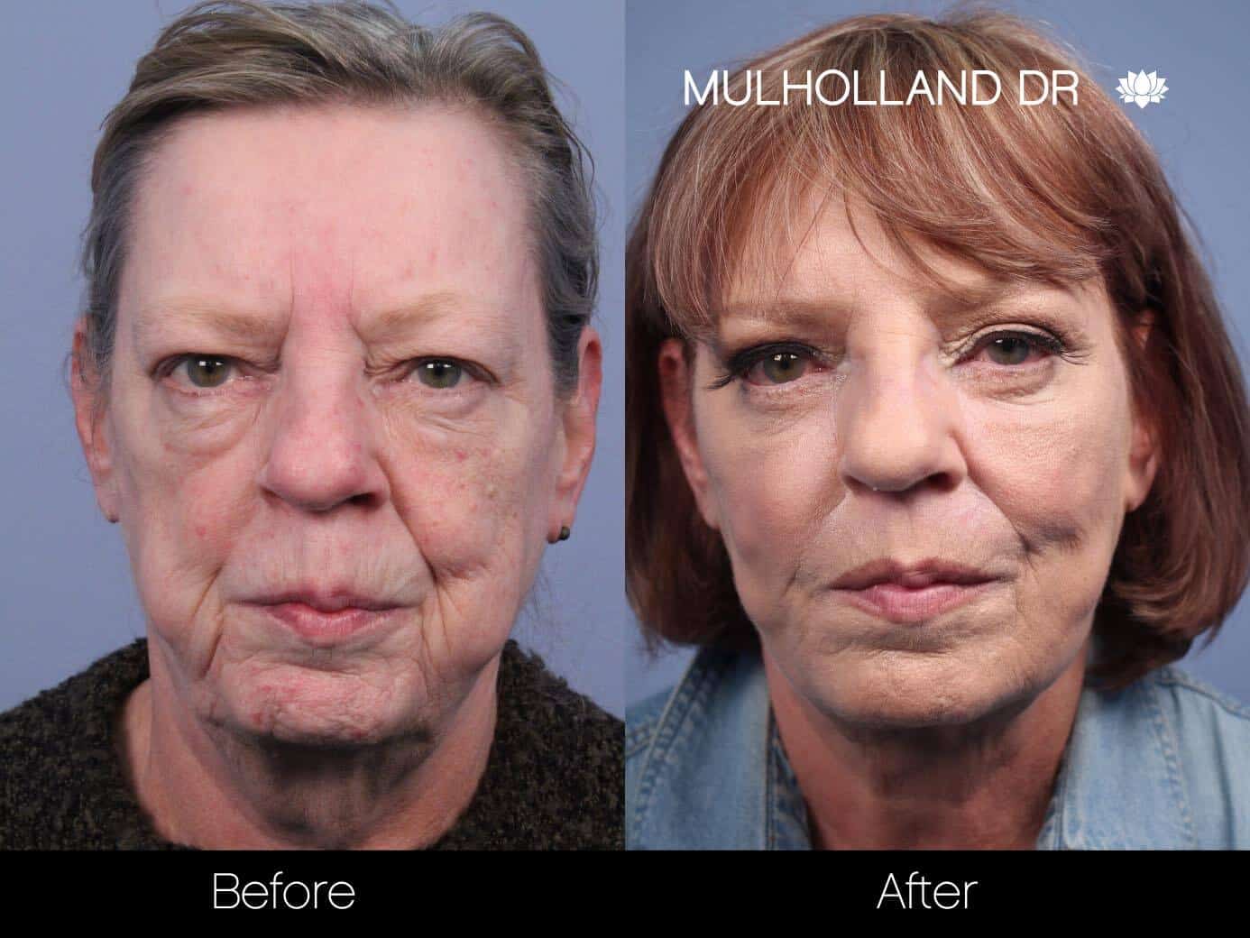 Cheek Lift - Before and After Gallery - Patient Photo 53