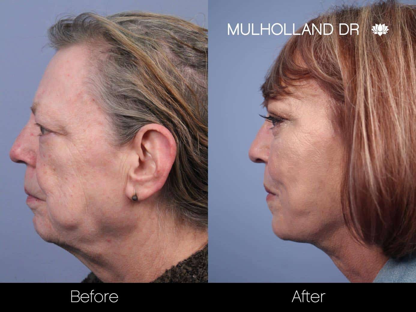 Cheek Lift - Before and After Gallery - Patient Photo 54