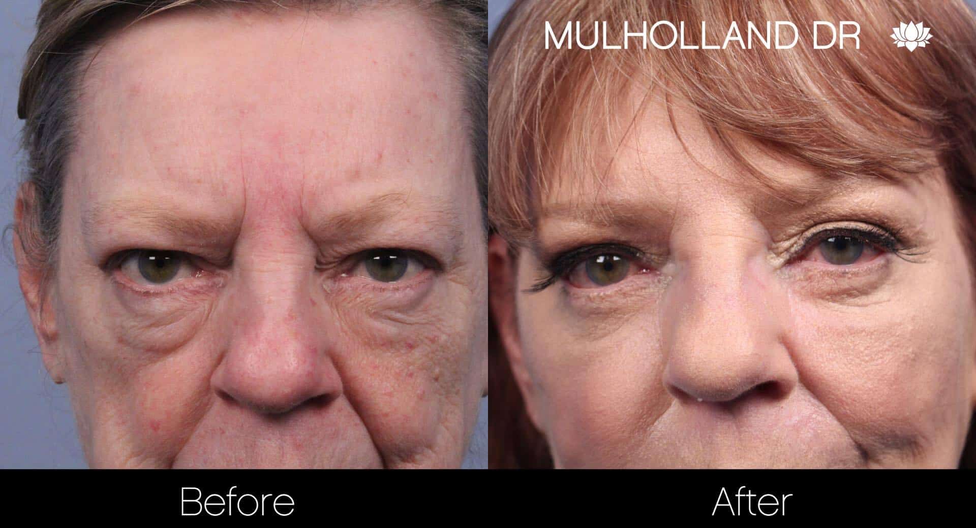 Cheek Lift - Before and After Gallery - Patient Photo 58