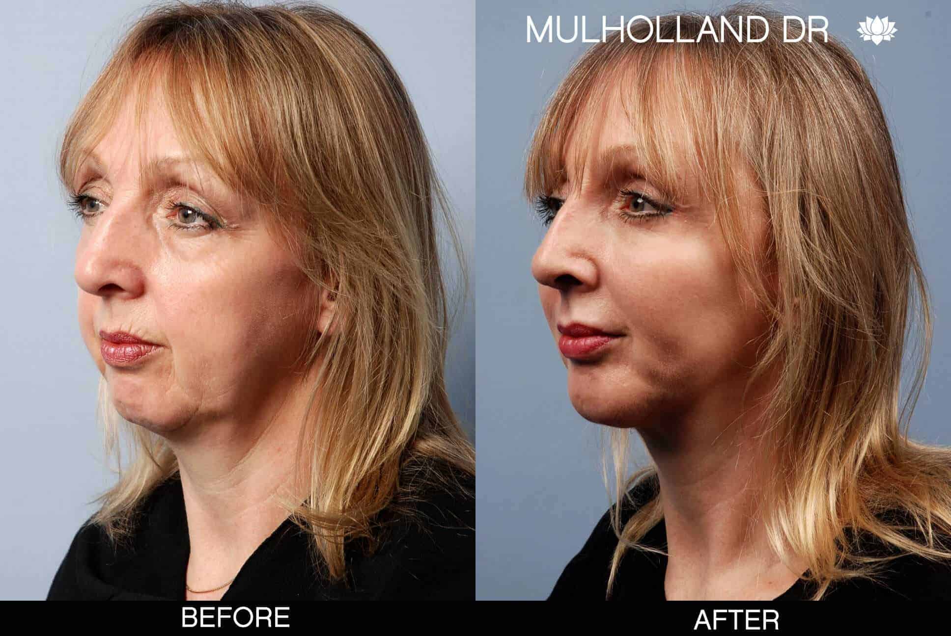 Cheek Lift - Before and After Gallery - Patient Photo 6